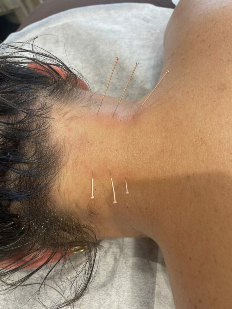 Acupuncture in Kent